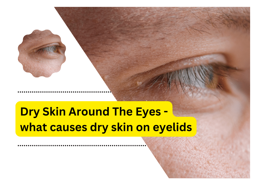 Dry Skin Around The Eyes What Causes Dry Skin On Eyelids 
