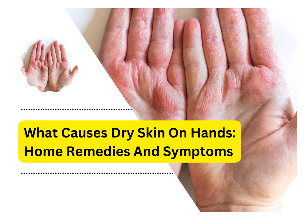 What Causes Dry Skin On Hands Home Remedies And Symptoms