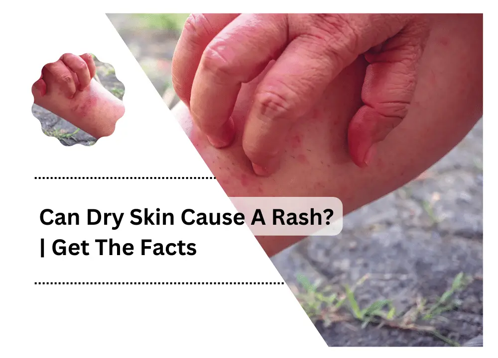 can-dry-skin-cause-a-rash-get-the-facts