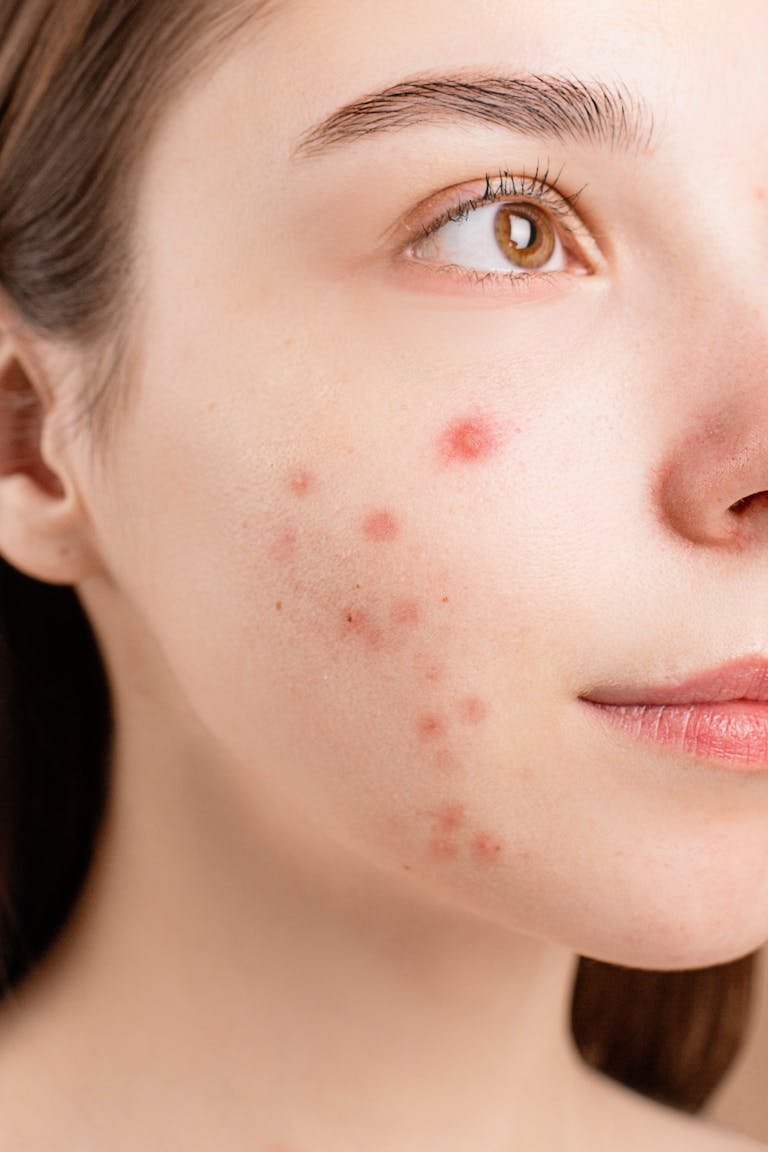 Skincare For Dry Acne Prone Skin